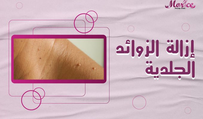 علاج الزوائد الجلدية في المناطق الحساسة